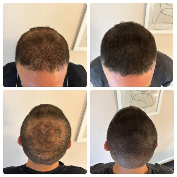Durée des résultats micropigmentation