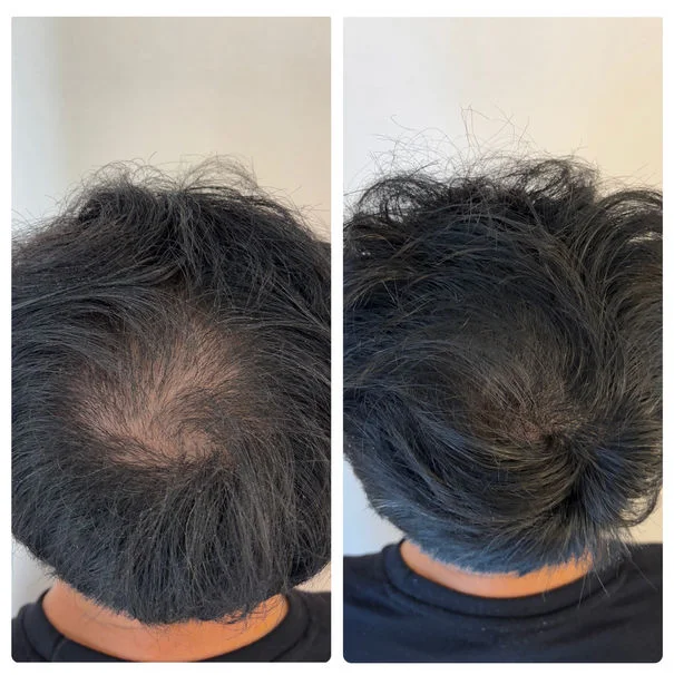 Patch test micropigmentation