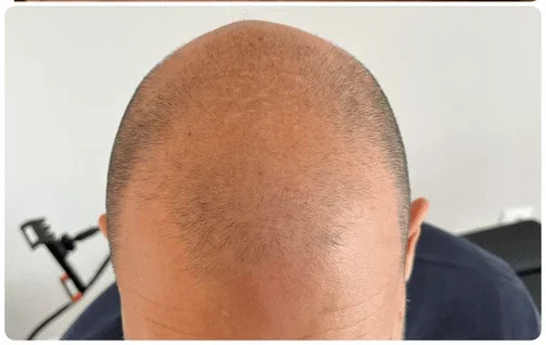 Résultat micropigmentation homme